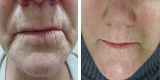 ProCell Lips After Microneedling Treatment